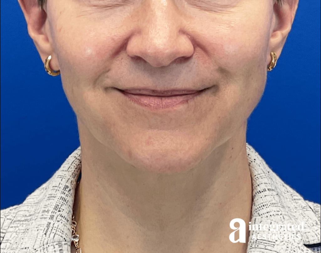 Dermal Filler, Botox, Sculptra, and Sofwave