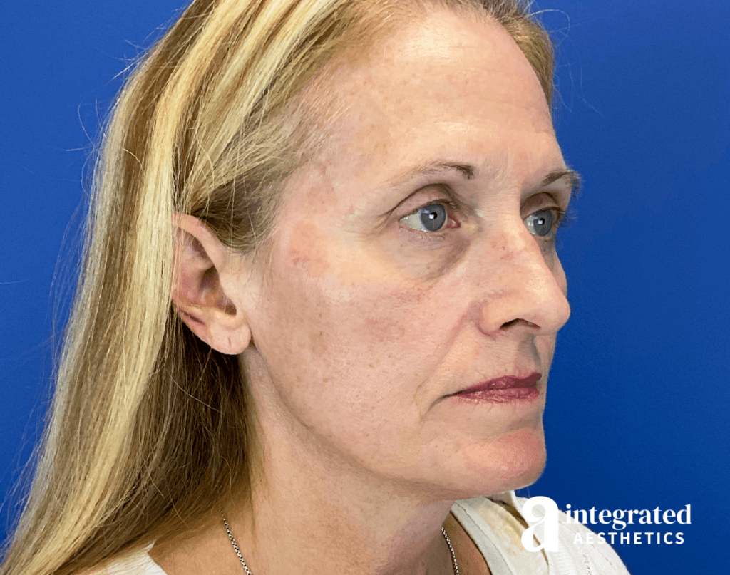 28910-full-face-rejuvenation-after-angled-left-15