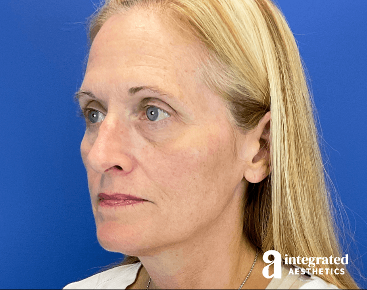 28910-full-face-rejuvenation-after-angledright