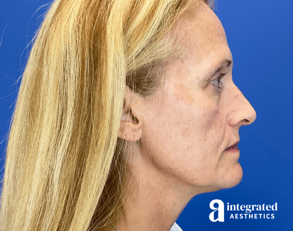28910-full-face-rejuvenation-after-left-21