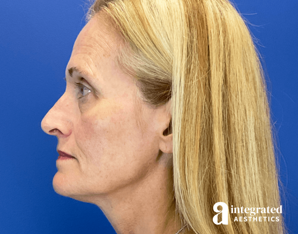28910-full-face-rejuvenation-after-right-17