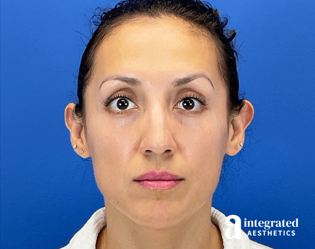 29365-botox-after-brows-raised-15