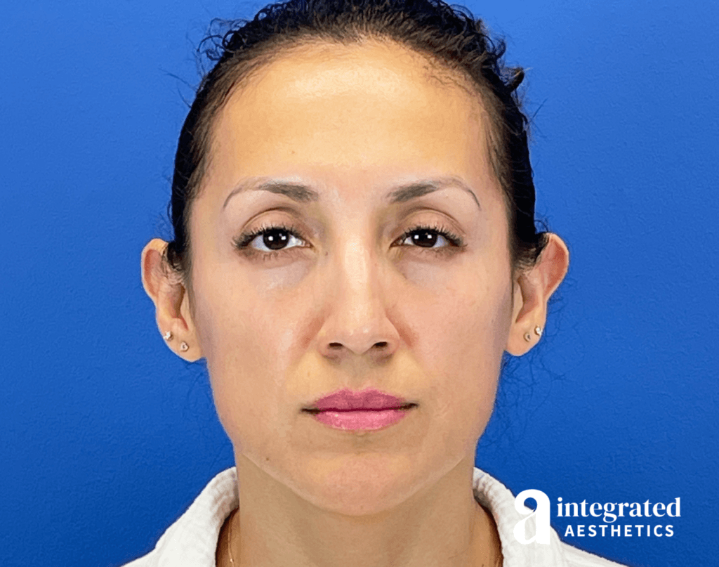 29365-botox-after-frown-13