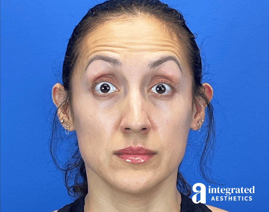 29365-botox-before-brows-raised-14