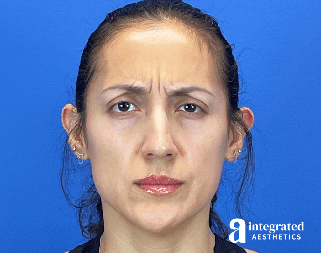 29365-botox-before-frown-12
