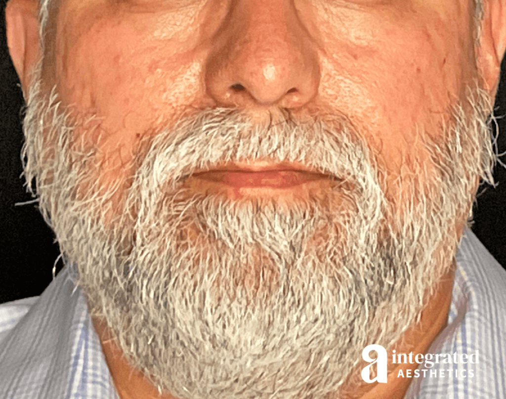 54-year-old male patient before Microneedling and Sculptra treatment with Dr. Melissa Chiang in The Woodlands, TX.