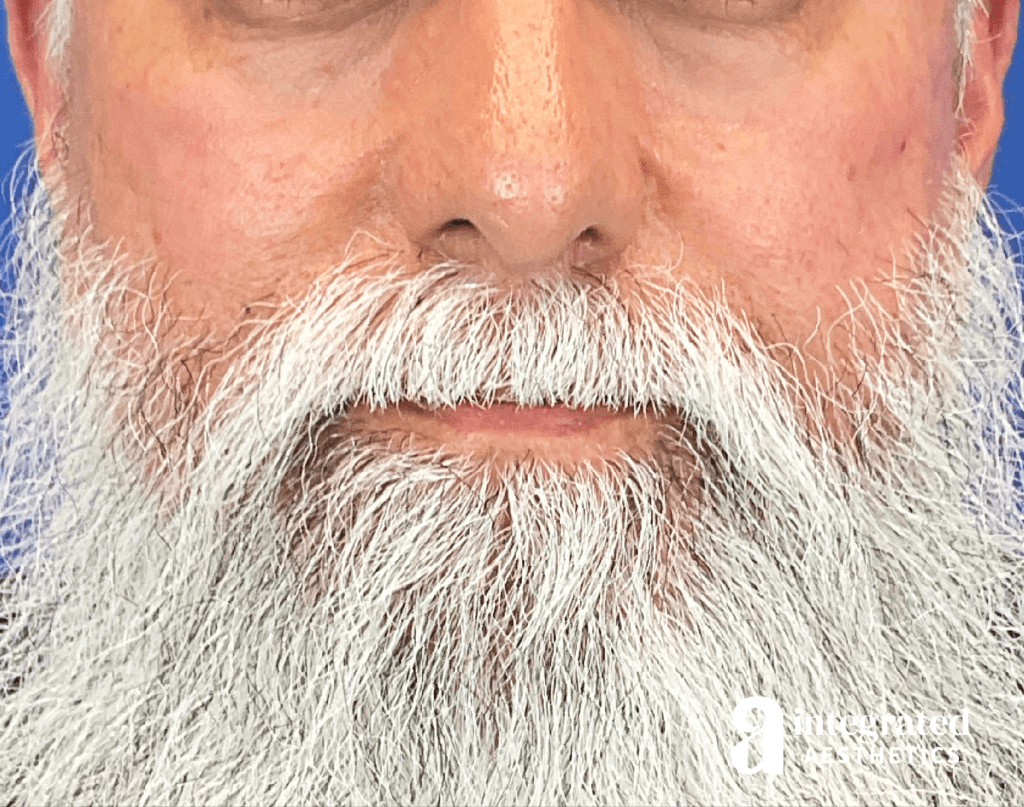 54-year-old male patient after Microneedling and Sculptra treatment with Dr. Melissa Chiang in The Woodlands, TX.