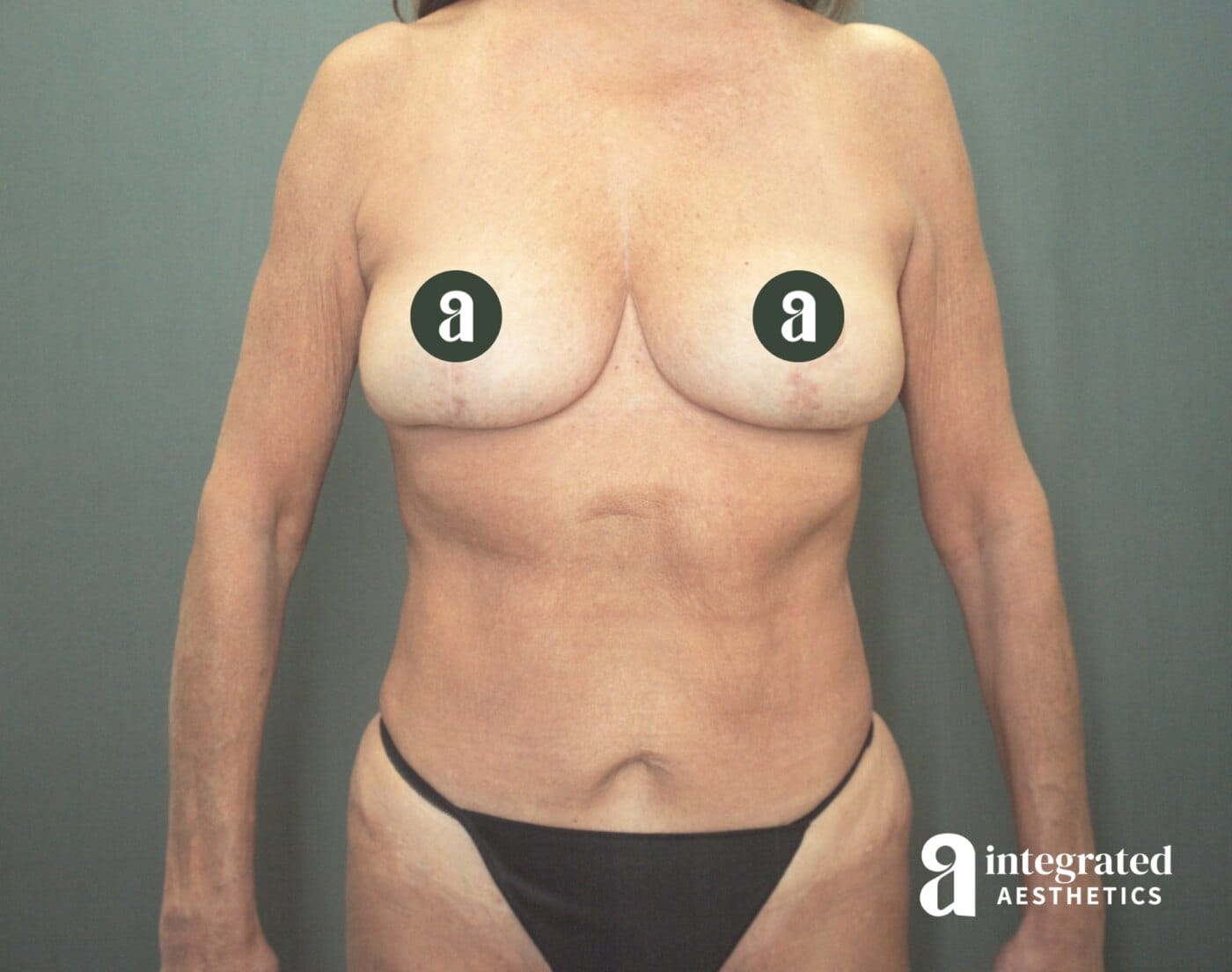 Complex Body Contouring Case Study: Mommy Makeover & Precision Revision in The Woodlands & Spring, TX