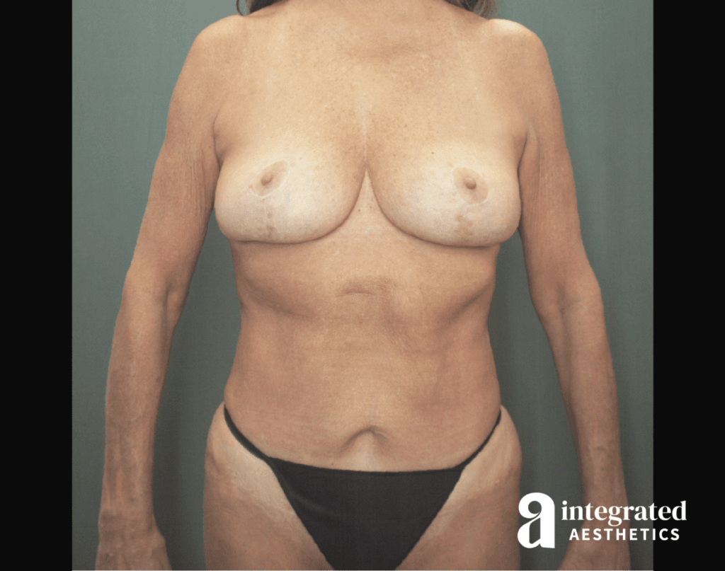 59-year-old female patient after mommy makeover procedure with Dr. Young Cho in Spring, TX. 