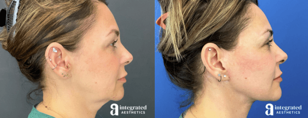 Side view 43-year-old facelift patient by Woodlands plastic surgeon Dr. Young Cho 