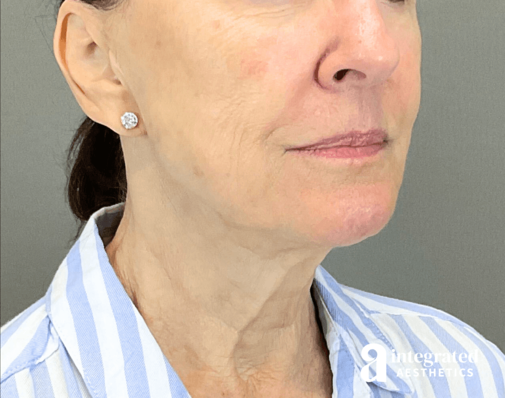 3395-sofwave-and-ultherapy-treatment-after-angled-left-15