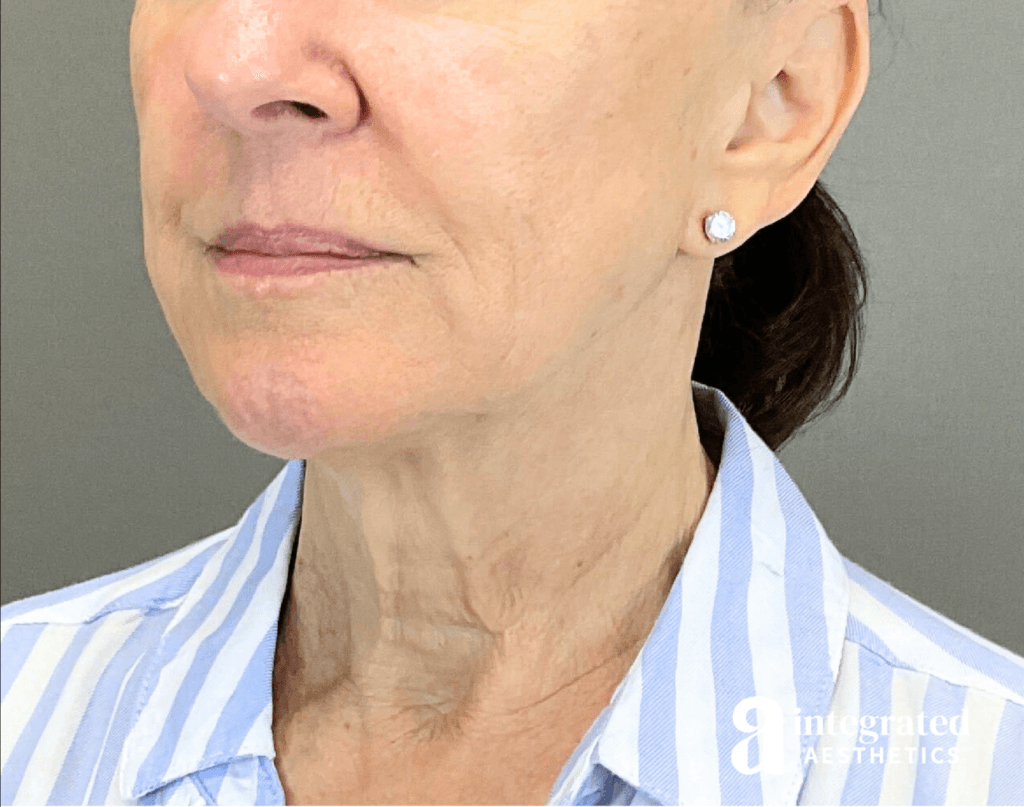 3395-sofwave-and-ultherapy-treatment-after-angled-right-13