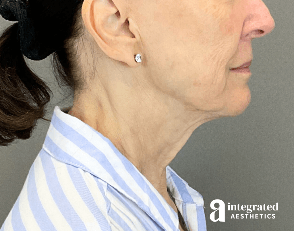 3395-sofwave-and-ultherapy-treatment-after-left-23