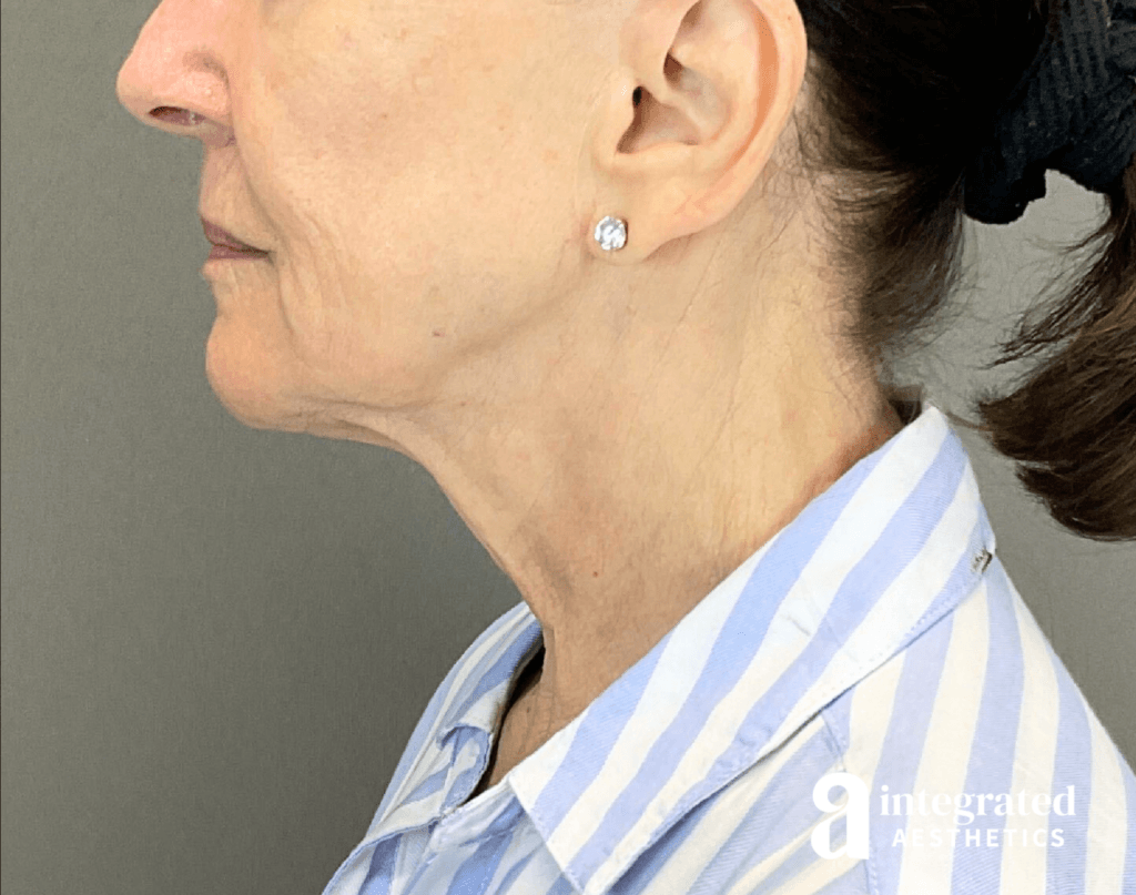 3395-sofwave-and-ultherapy-treatment-after-right-17