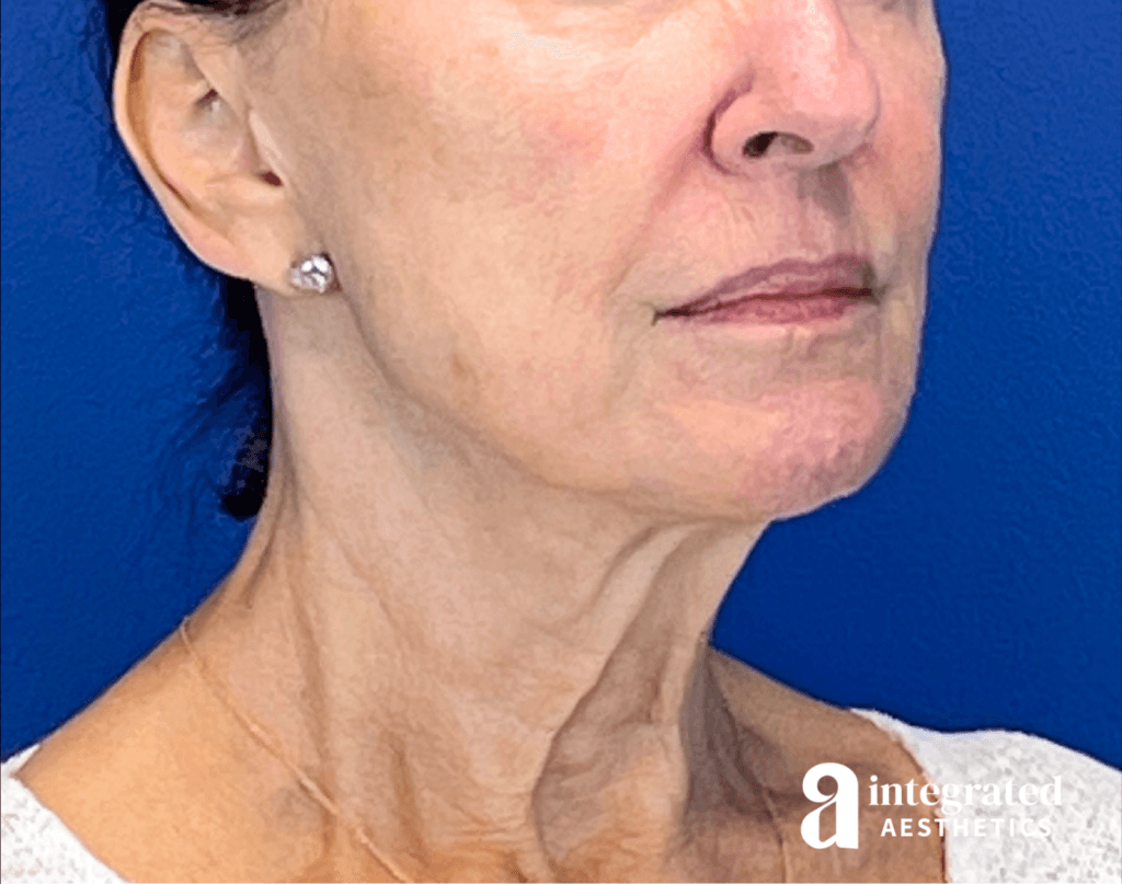 3395-sofwave-and-ultherapy-treatment-before-angled-left-14
