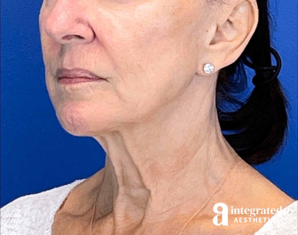 3395-sofwave-and-ultherapy-treatment-before-angled-right-12