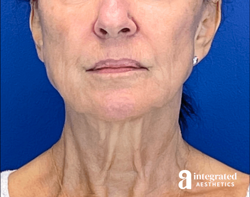 Sofwave and Ultherapy