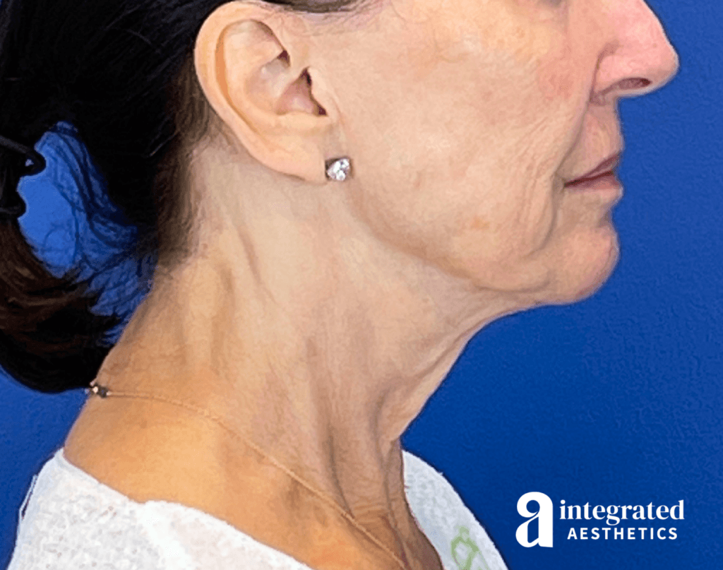 3395-sofwave-and-ultherapy-treatment-before-left-22