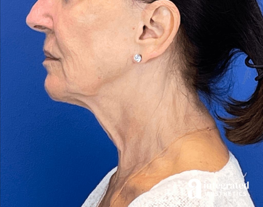 3395-sofwave-and-ultherapy-treatment-before-right-16