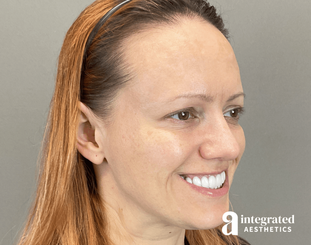 8707-botox-after-angled-left-26