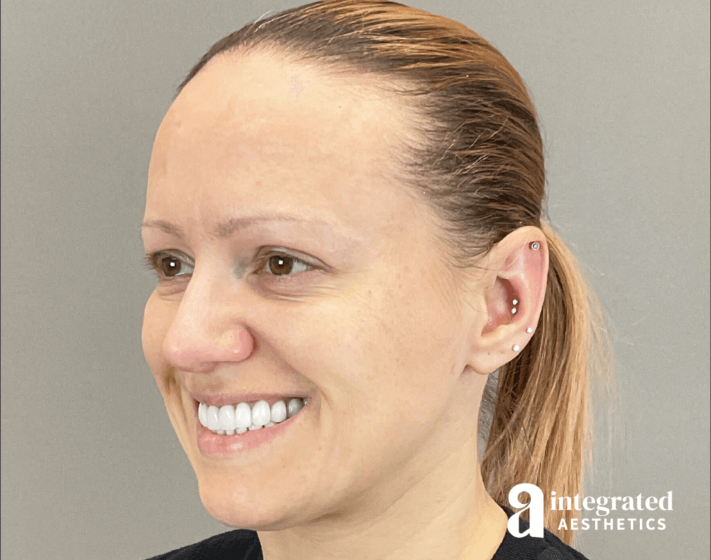 8707-botox-before-angled-right-22