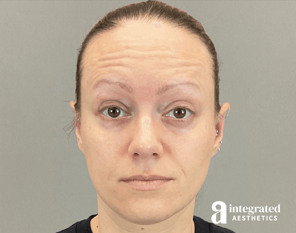 8707-botox-before-brows-raised-12