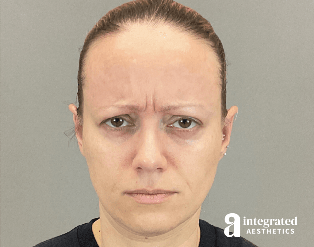 8707-botox-before-frown-14