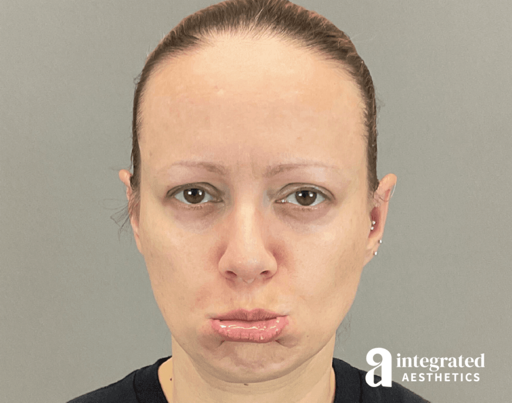 8707-botox-before-pout-16